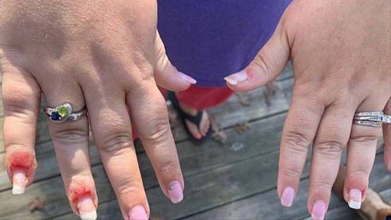 Женщина показала, во что грибок превратил ее руки после маникюра с пудрой - usa.one - шт.Северная Каролина