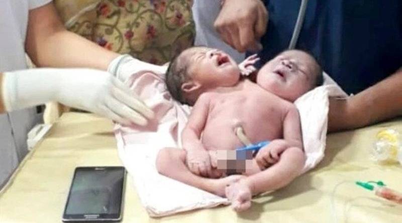 Женщина потеряла сознание от шока, когда родила ребенка с двумя головами и тремя руками (видео) - usa.one - Индия