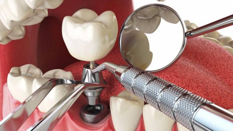 Сколько стоит зубной имплантат и какую часть возместит больничная касса? - germania.one - Германия
