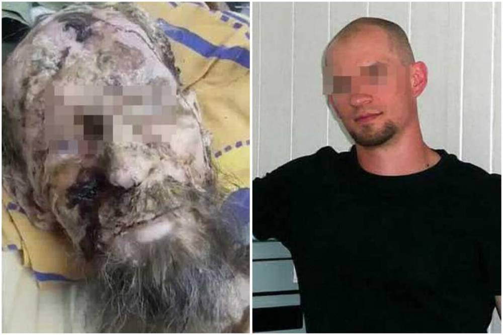 Врач из Актобе рассказал о пациенте, названном мировыми СМИ "живой мумией" (фото) - nur.kz - Англия - Актобе