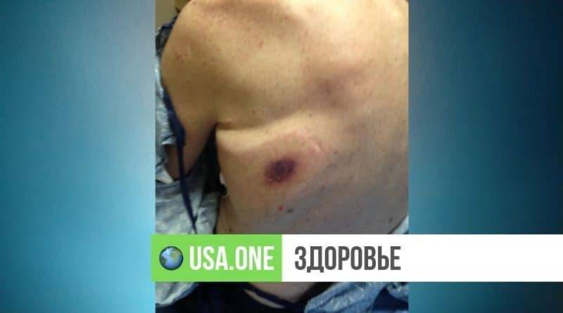 «Он умер за 48 часов»: жителя Мемфиса убила плотоядная бактерия - usa.one - Техас - шт.Флорида