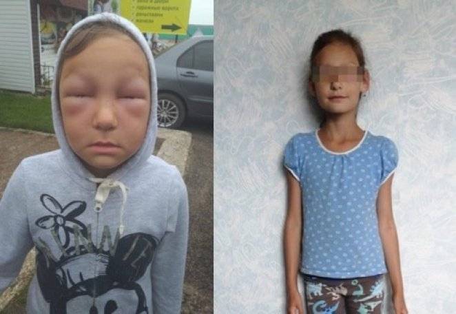 В Башкирии 8-летняя девочка находится в критическом состоянии из-за укусов пчел - gorobzor.ru - Башкирия - район Дуванский