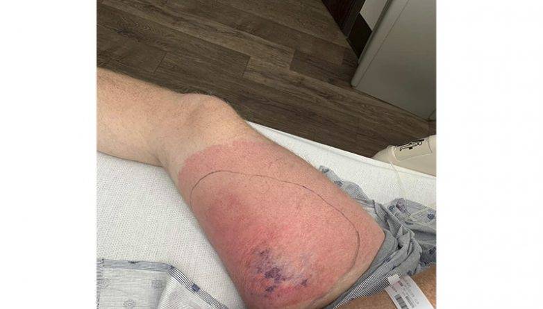 Абсолютно здоровый мужчина из Алабамы заразился плотоядной бактерией после катания на каяках - usa.one - штат Теннесси - штат Алабама