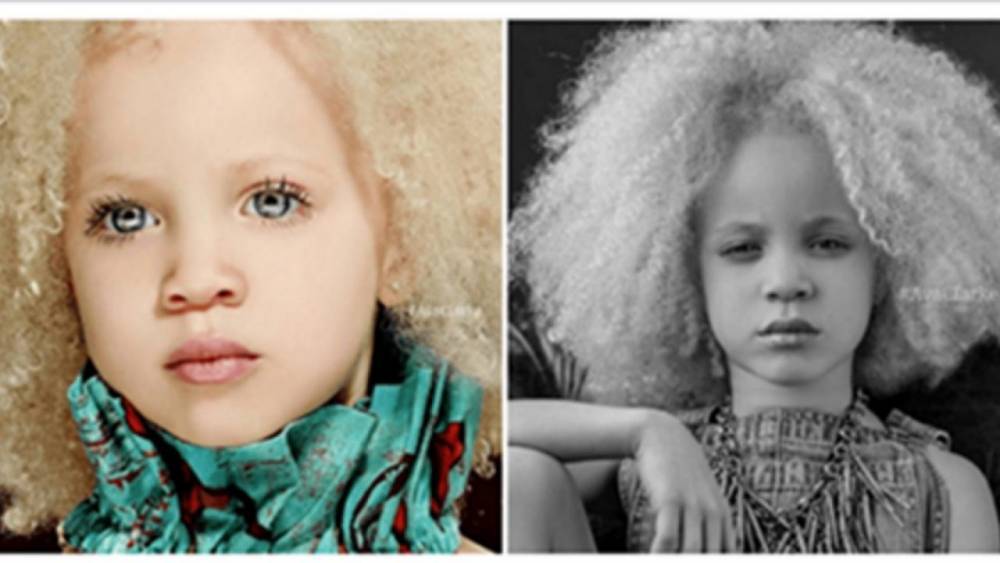 Девочка-альбинос смогла не только приспособится к жизни, но и стать моделью - lemurov.net