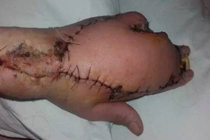 Женщина получила царапину от кота, лишилась пальца и едва не умерла - lenta.ru - Англия - Шотландия - Португалия - Глазго