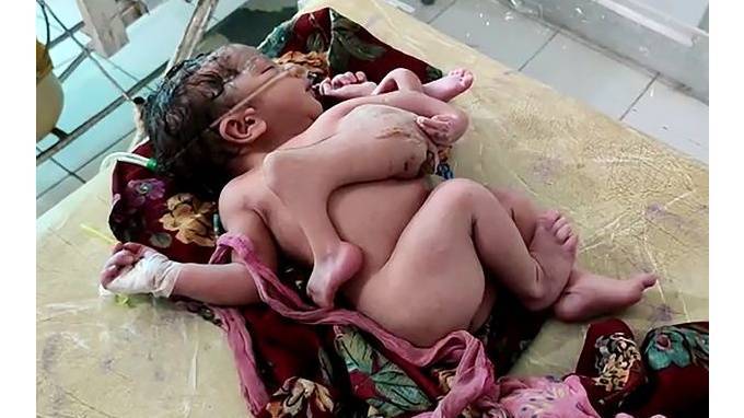 В Индии родился ребенок с четырьмя ногами и тремя руками - piter.tv - India