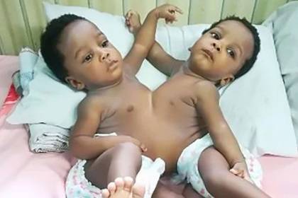78 медработников 13 часов разделяли сросшихся близняшек - lenta.ru - Нигерия - Абуджа