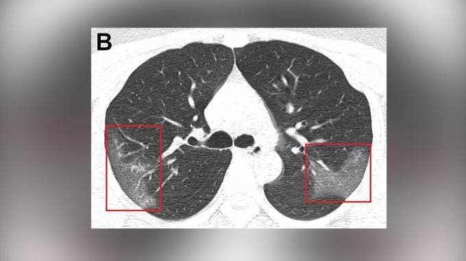 Китайские медики показали снимки легких, которые поражены коронавирусом - piter.tv - Китай