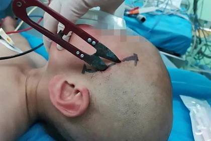 Ребенок проткнул свой череп большими ножницами и выжил - lenta.ru - Китай