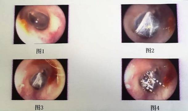 Паук поселился в ухе пожилой жительницы Китая - Cursorinfo: главные новости Израиля - cursorinfo.co.il - Китай - Израиль