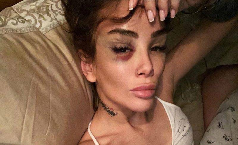 Айза Анохина - «Знаю, что я дура!»: Айза страдает от боли после подтяжки лица - bloknot.ru