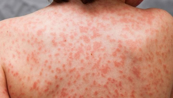 Коронавирус вызывает опасный синдром, поражающий детей - vesti.ru - Англия