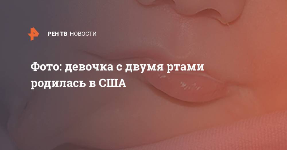 Фото: девочка с двумя ртами родилась в США - ren.tv - США