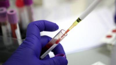 SARS-CoV-2 может спровоцировать волчанку и другие аутоиммунные заболевания - iz.ru - Колумбия
