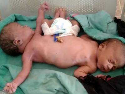 У жительницы Индии родились сиамские близнецы с двумя ногами и четырьмя руками - golos.ua - Индия - штат Уттар-Прадеш