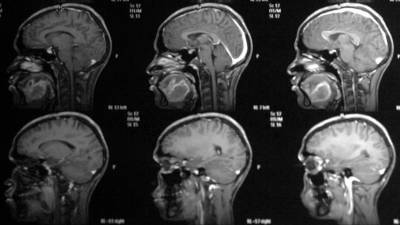 Михаил Мяснянкин - Онколог назвал основные симптомы рака головного мозга - russian.rt.com