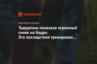 Регина Тодоренко - Роман Костомаров - Татьяна Навка - Тодоренко показала огромный синяк на бедре. Это последствия тренировок с Костомаровым - championat.com