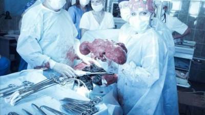 Во Львове хирурги удалили тернополянке 10-килограммовую опухоль - ru.espreso.tv - Львов - Тернополь