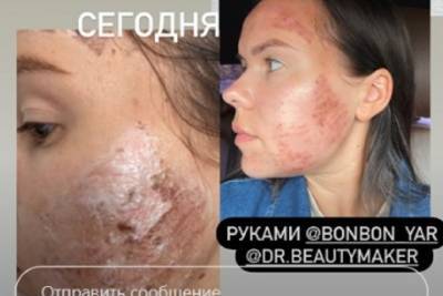 В Ярославле горе-косметологи сожгли лицо пациентке - yar.mk.ru - Ярославль