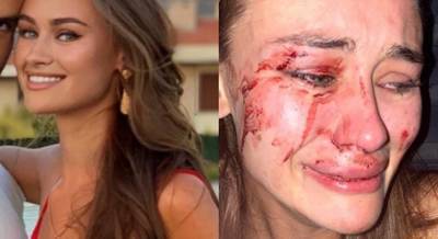 Мехмет Нури Эрсой - Бойфренда - В избиении украинской модели на турецком курорте заподозрили ее бойфренда - unian.net - Украина - Турция