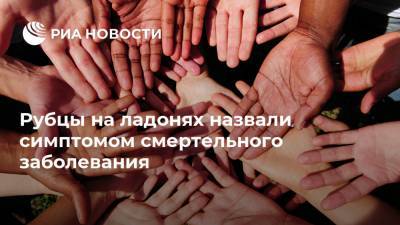 Рубцы на ладонях назвали симптомом смертельного заболевания - ria.ru - Москва