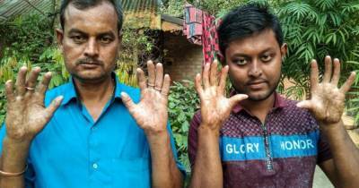 Без отпечатков пальцев. Как живут люди с редкой генетической мутацией - focus.ua - Бангладеш