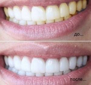 ​Натуральное отбеливание зубов - skuke.net