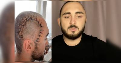 Блогер - В Киеве блогер лишился части черепа после просьбы угостить сигаретой (видео) - focus.ua - Украина - Киев