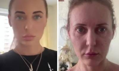 За месяц постарела на 10 лет: девушка рассказала, как косметолог испортила ей внешность - gubdaily.ru - Пермь