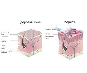 Псориаз: натуральный рецепт для лечения - goodnews.ua