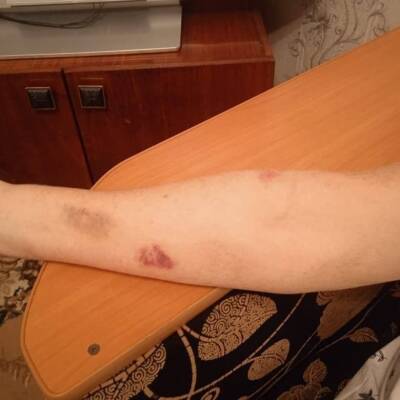 В Новосибирске женщину с диабетом привязали к кровати и морили голодом в ковидной больнице - znak.com - Новосибирск