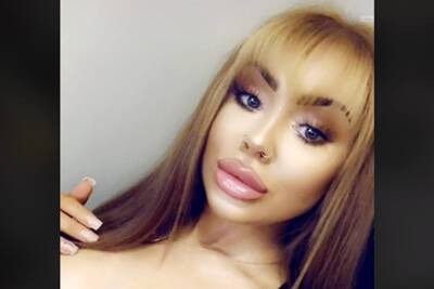 Зависимая от филлеров девушка показала свою внешность после четырех лет инъекций - lenta.ru