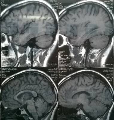 Ученые обнаружили потенциальную причину болезни Альцгеймера - ufacitynews.ru