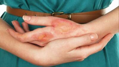 Счет на секунды: что делать при ожоге серной кислотой в первую очередь - 5-tv.ru