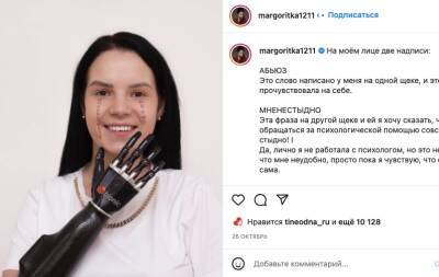 Маргарита Грачева - ЕСПЧ назначил компенсацию Маргарите Грачевой, которой экс-супруг отрубил кисти рук - neva.today - Россия - Санкт-Петербург