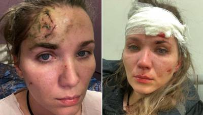 Анастасия Веденская - Актриса Веденская выложила фото после избиений в Петербурге - gazeta.ru - Санкт-Петербург