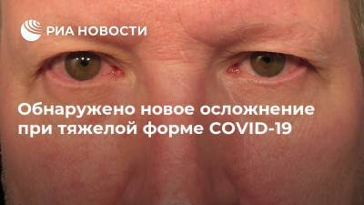 Обнаружено новое осложнение при тяжелой форме COVID-19 - ria.ru - Москва - Франция