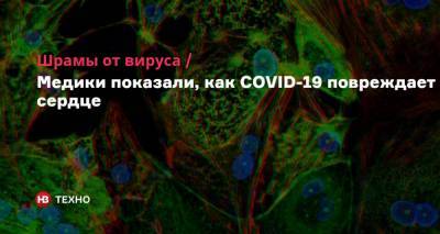 Шрамы от вируса. Медики показали, как COVID-19 повреждает сердце - nv.ua - Washington