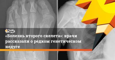 «Болезнь второго скелета»: врачи рассказали оредком генетическом недуге - ridus.ru