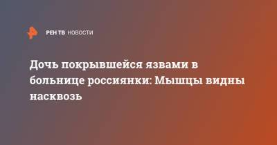 Дочь покрывшейся язвами в больнице россиянки: Мышцы видны насквозь - ren.tv - Ставрополье - Георгиевск