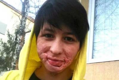 Обожженная отцом школьница: Он не попросил прощения. Ни видеть, ни слышать его не хочу - kp.ua