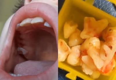 9-летней украинке вырвали 12 зубов одним махом: мама говорит, что согласие не давала - politeka.net