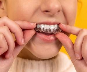 Ортодонтическое лечение: как и зачем исправляют прикус - goodnews.ua