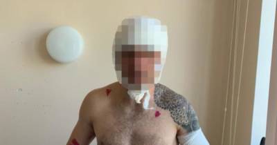 Медведь пытался содрать скальп с сахалинца, но тот притворился мертвым - ren.tv
