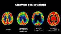 Впервые за 20 лет власти США одобрили лекарство от болезни Альцгеймера - vlasti.net - New York