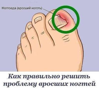 ​Как правильно решить проблему вросших ногтей и что такое ногтоеда - skuke.net