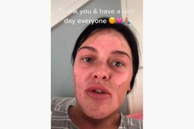 Женщина попыталась приготовить яйца по рецепту из TikTok и получила ожоги лица - lenta.ru - Англия