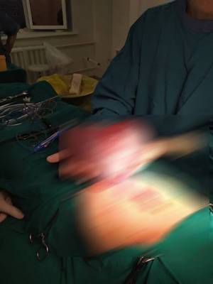 В Тюмени хирурги извлекли из живота ребенка 25-сантиметровую опухоль в форме сердца - nakanune.ru - Тюмень