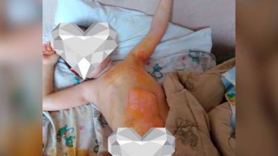 В Челябинской области мать не пускала врачей к 4-летнему ребенку с ожогами - vesti.ru - Челябинская обл. - Копейск