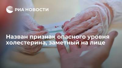 Ксантомы на лице могут быть признаками высокого уровня холестерина в крови - ria.ru - Москва - Англия - Великобритания
